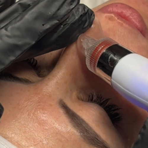 HydraGlow Facial result