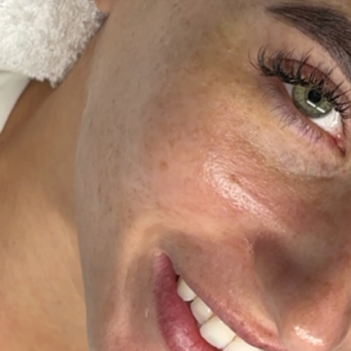 Dermaplane Add-On result